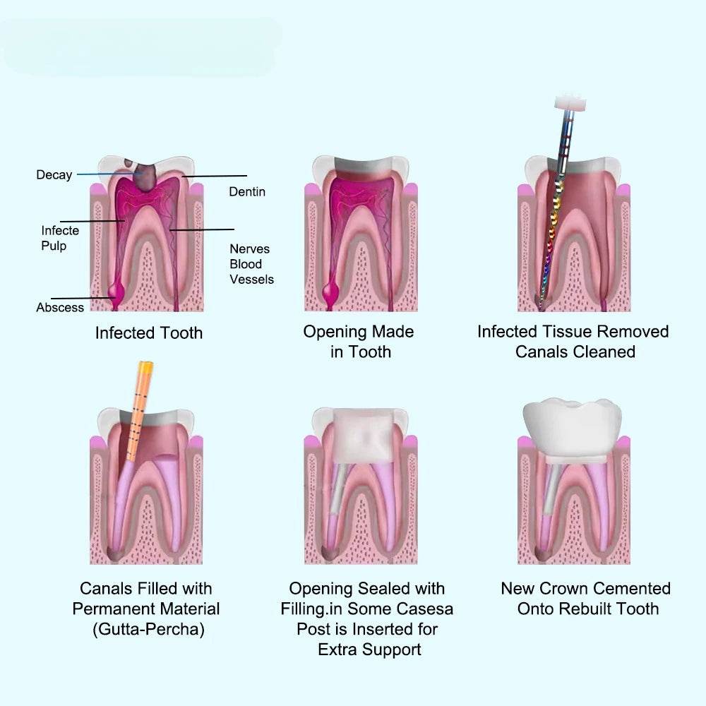 CYF335 Dental Pro-T Gutta Percha Points - Denspay Dental - Gutta Percha Points