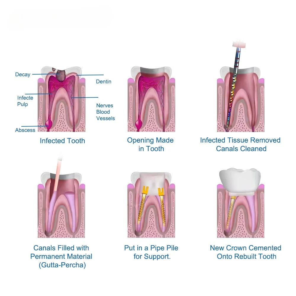 CYW838 Dental Screw Post