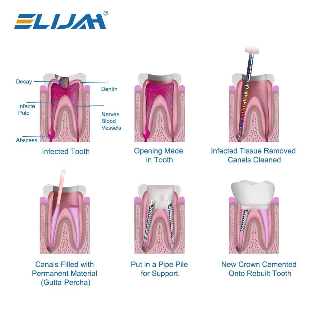 CYW837 Dental Screw Posts - Denspay Dental - Dental Mooser System