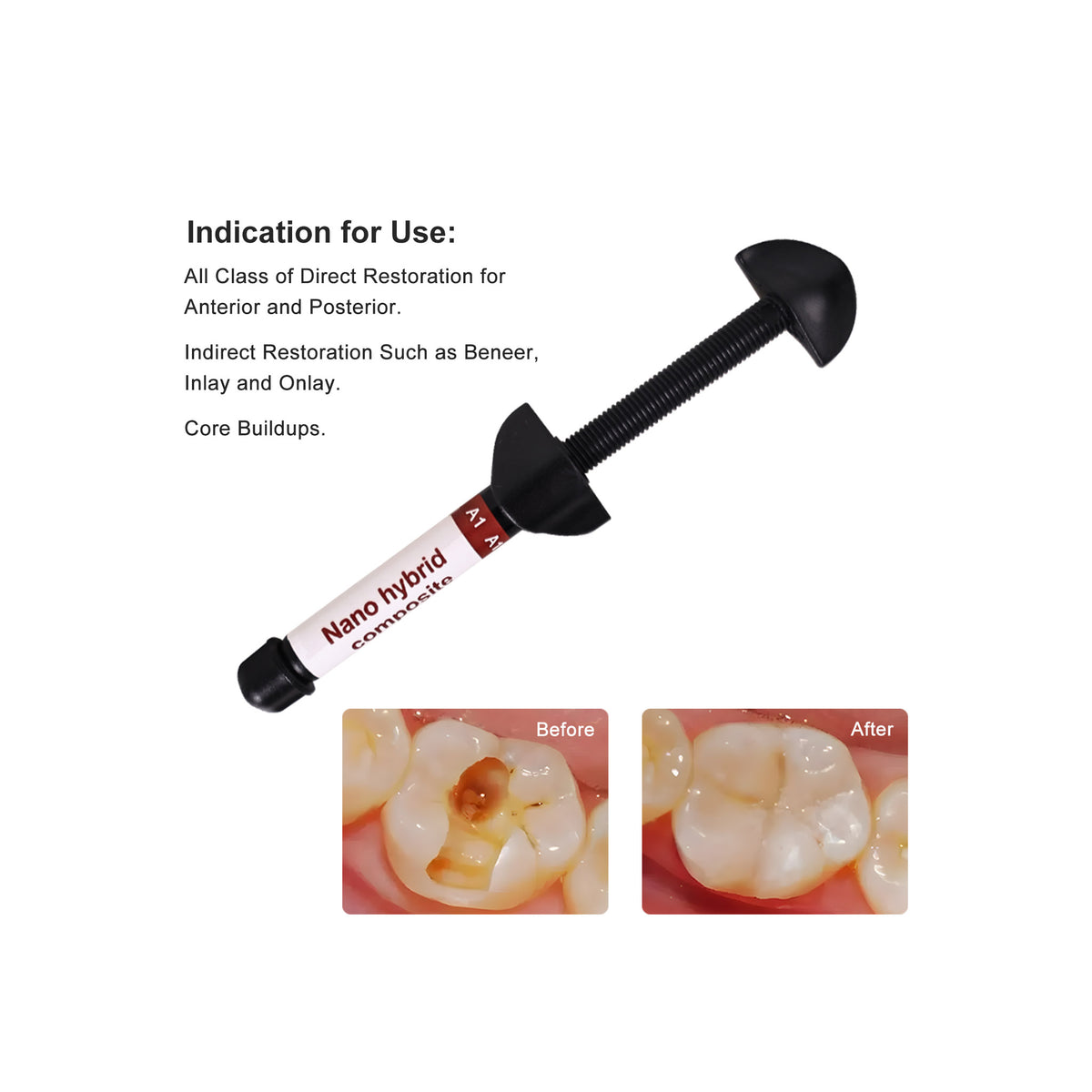 CYU204 Dental Nano Hybrid Composite Resin Kit