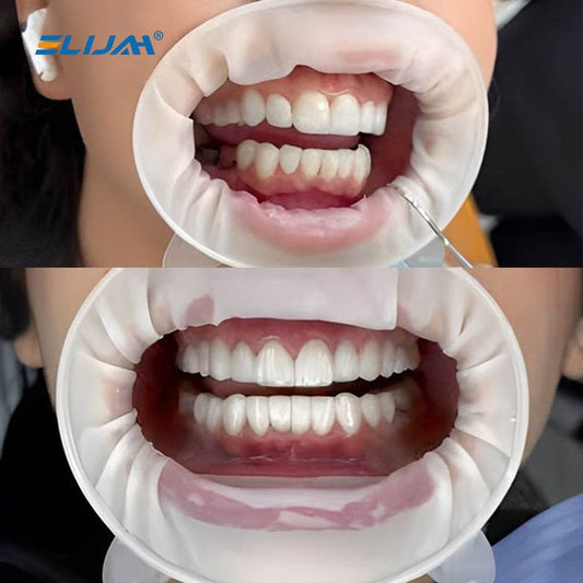 CYW835 Dental Rubber Mouth Opener - Denspay Dental - Mouth Opener