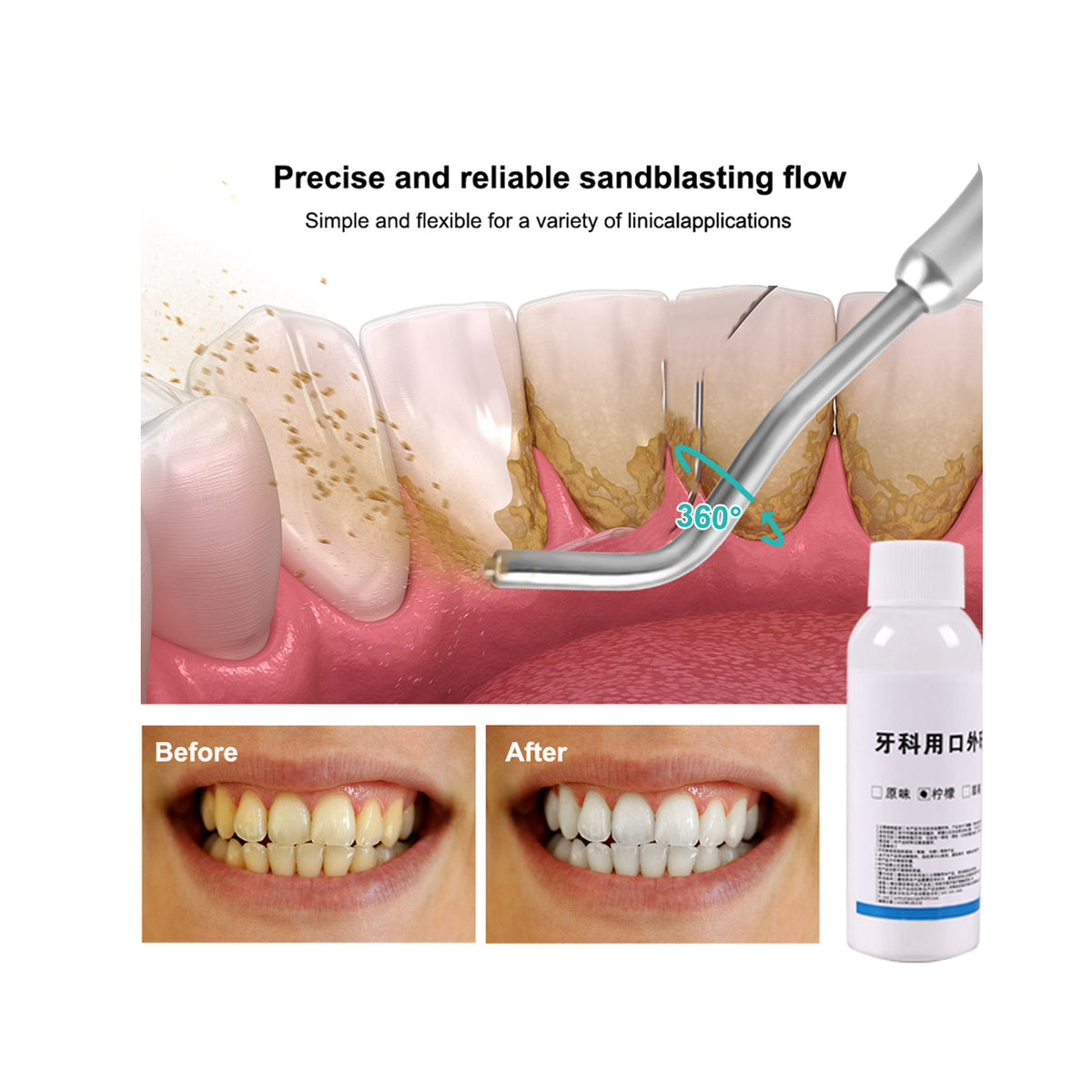 Air Polishing Clean Pigment On Tooth Surface