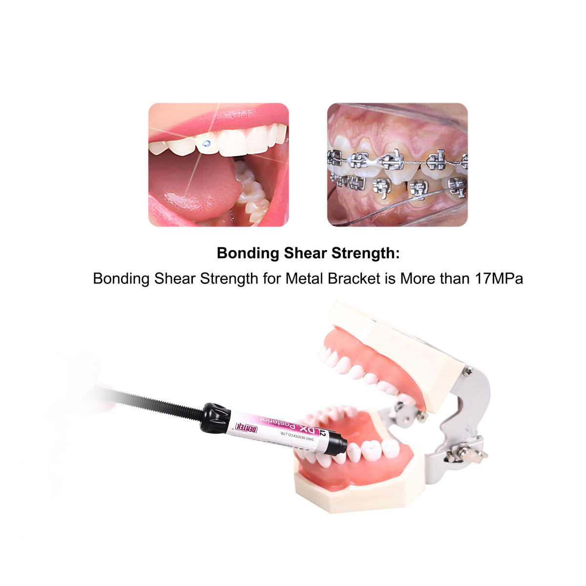 Anterior tooth aesthetic composite restoration clinical scene