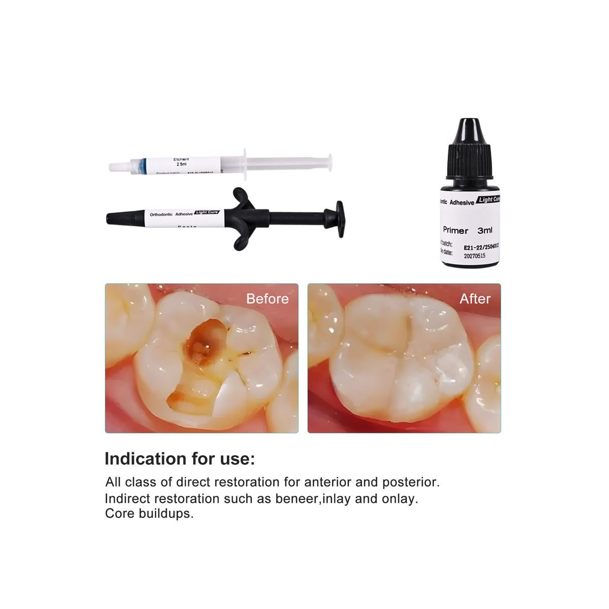 Apply Ortho Adhesive Paste On Bracket