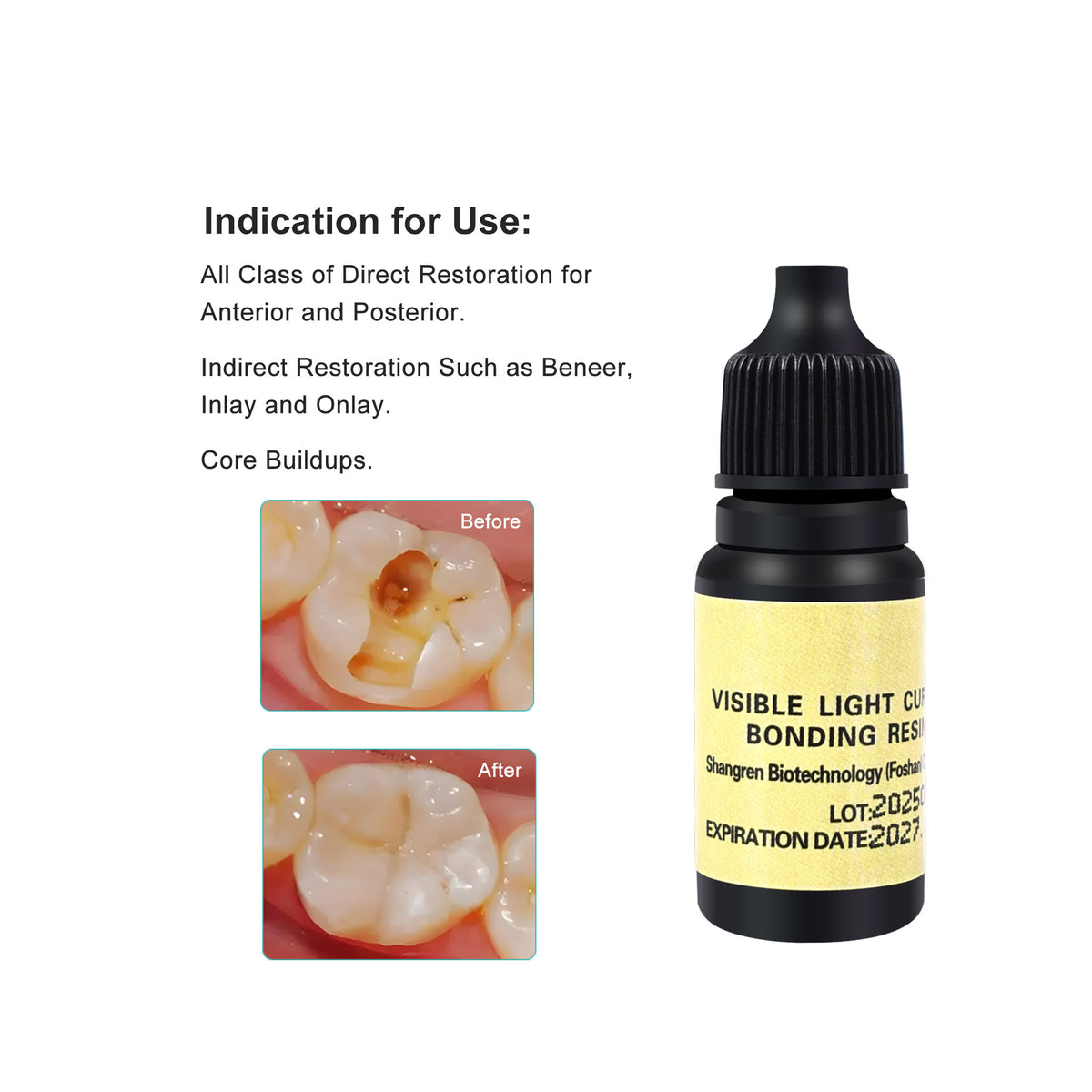 Bonding for Composite Resin Filling