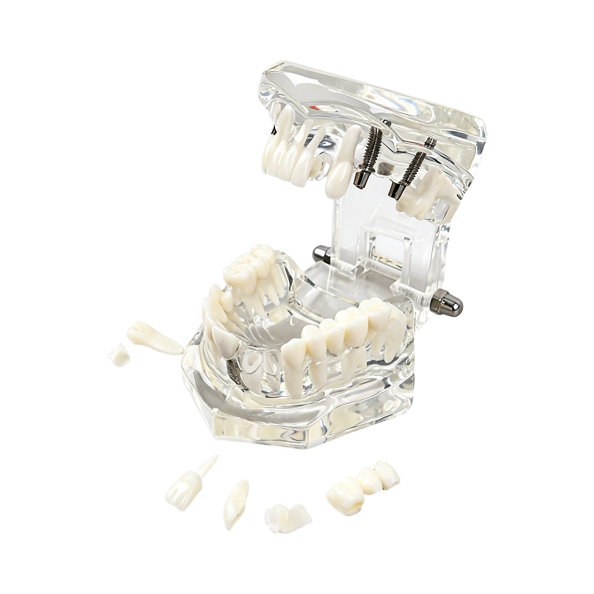 Close-up of caries and decayed tooth lesion on model