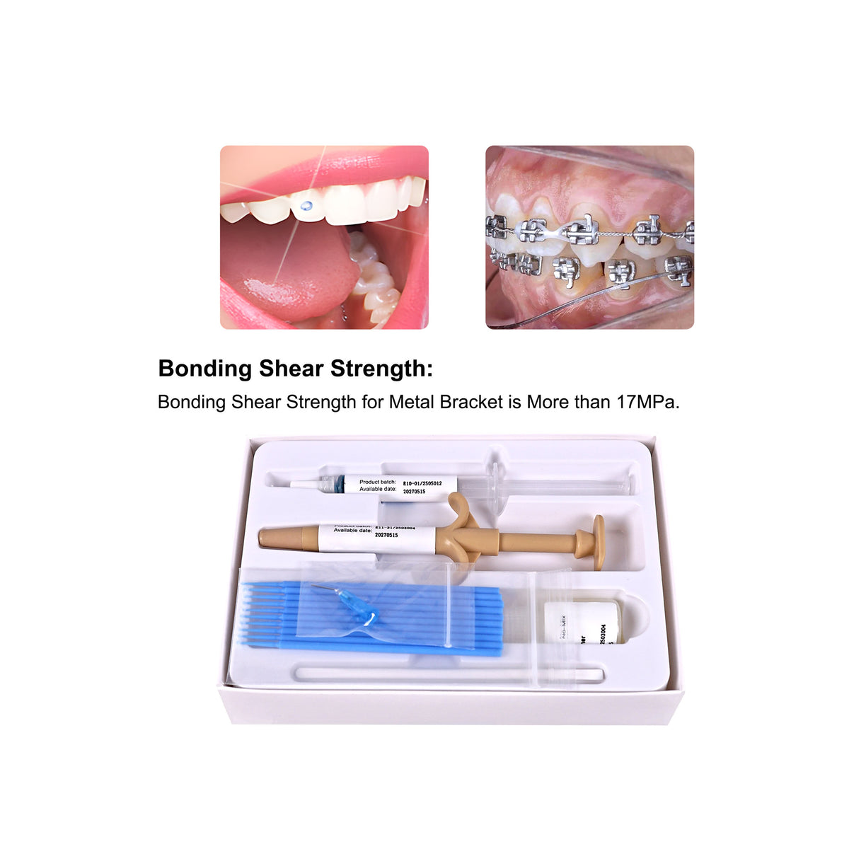 Etching Tooth Enamel Before Bracket Bonding