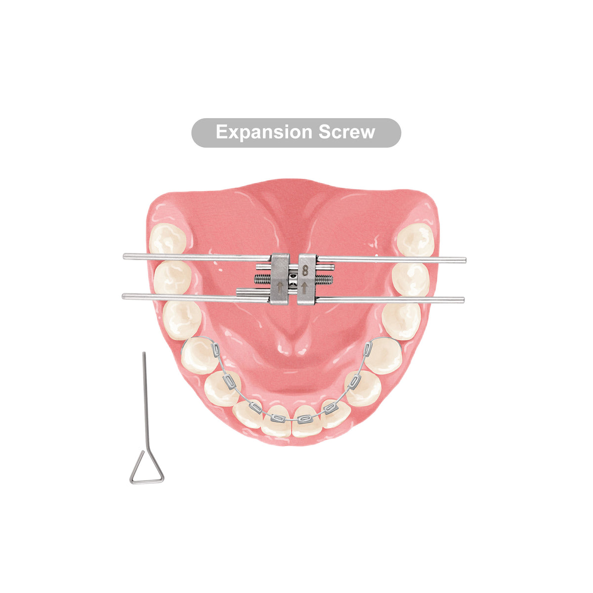 Expansion screw mounted on dental model demo