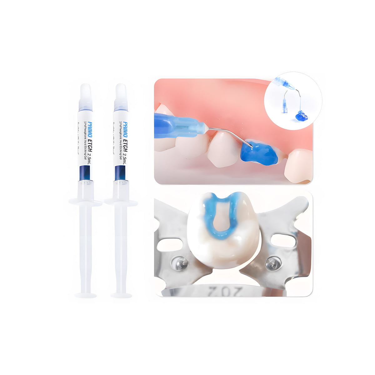 Extruded blue phosphoric acid etching gel texture