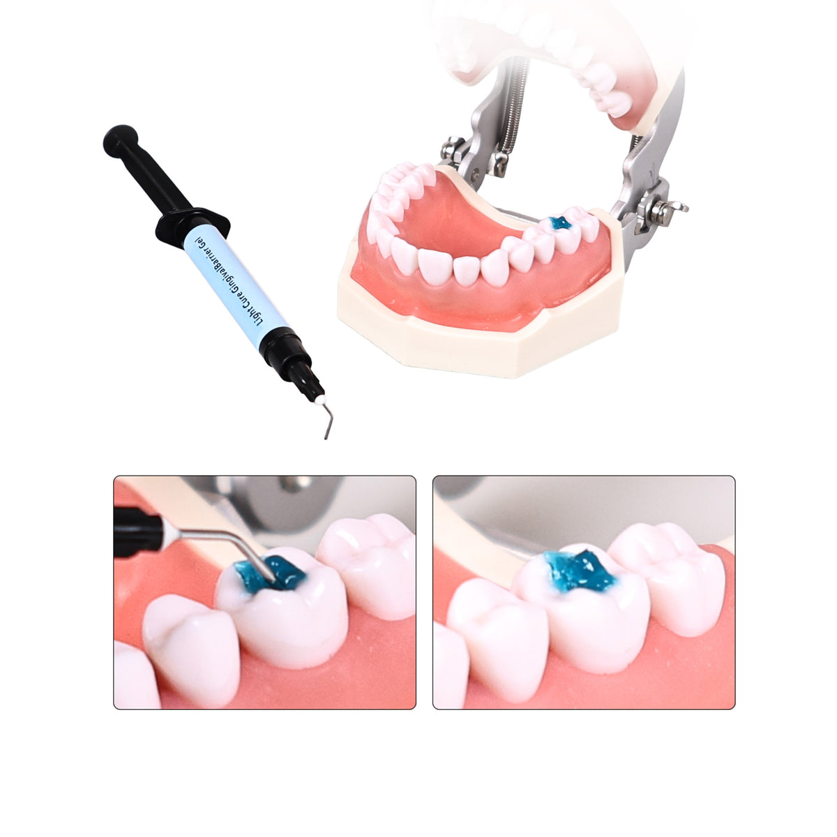 Gingival Barrier Used With Teeth Whitening Agent