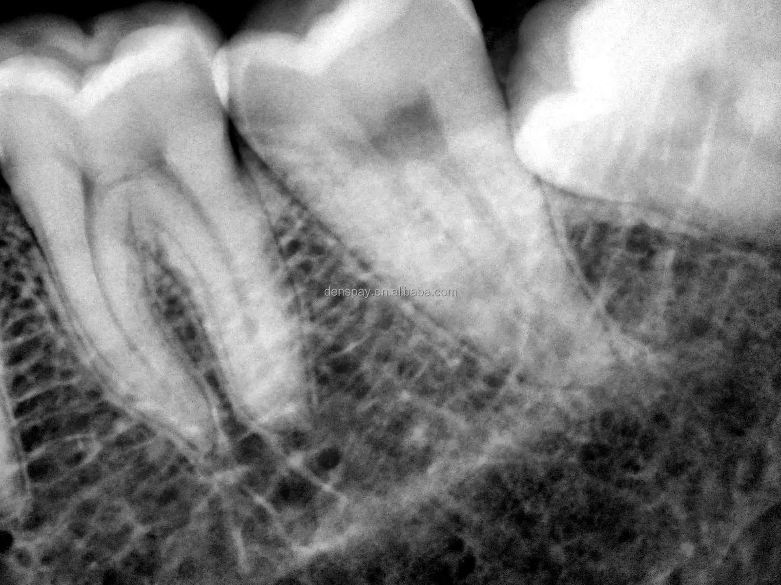 CYG062 Portable Dental X-ray Machine 60KV Toshiba Tube - Denspay Dental - 