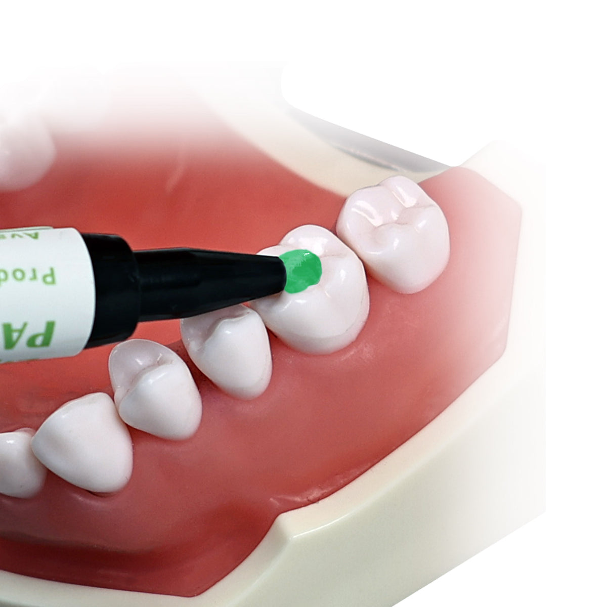 Light curing after bracket placement