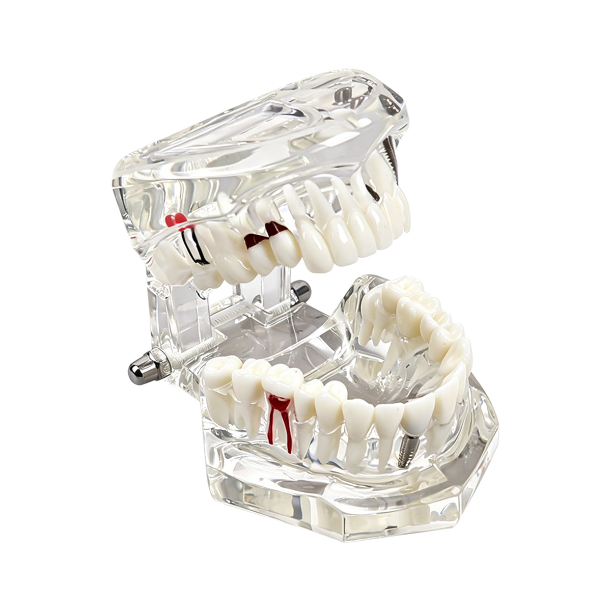 Multi-angle collage of transparent dental disease model