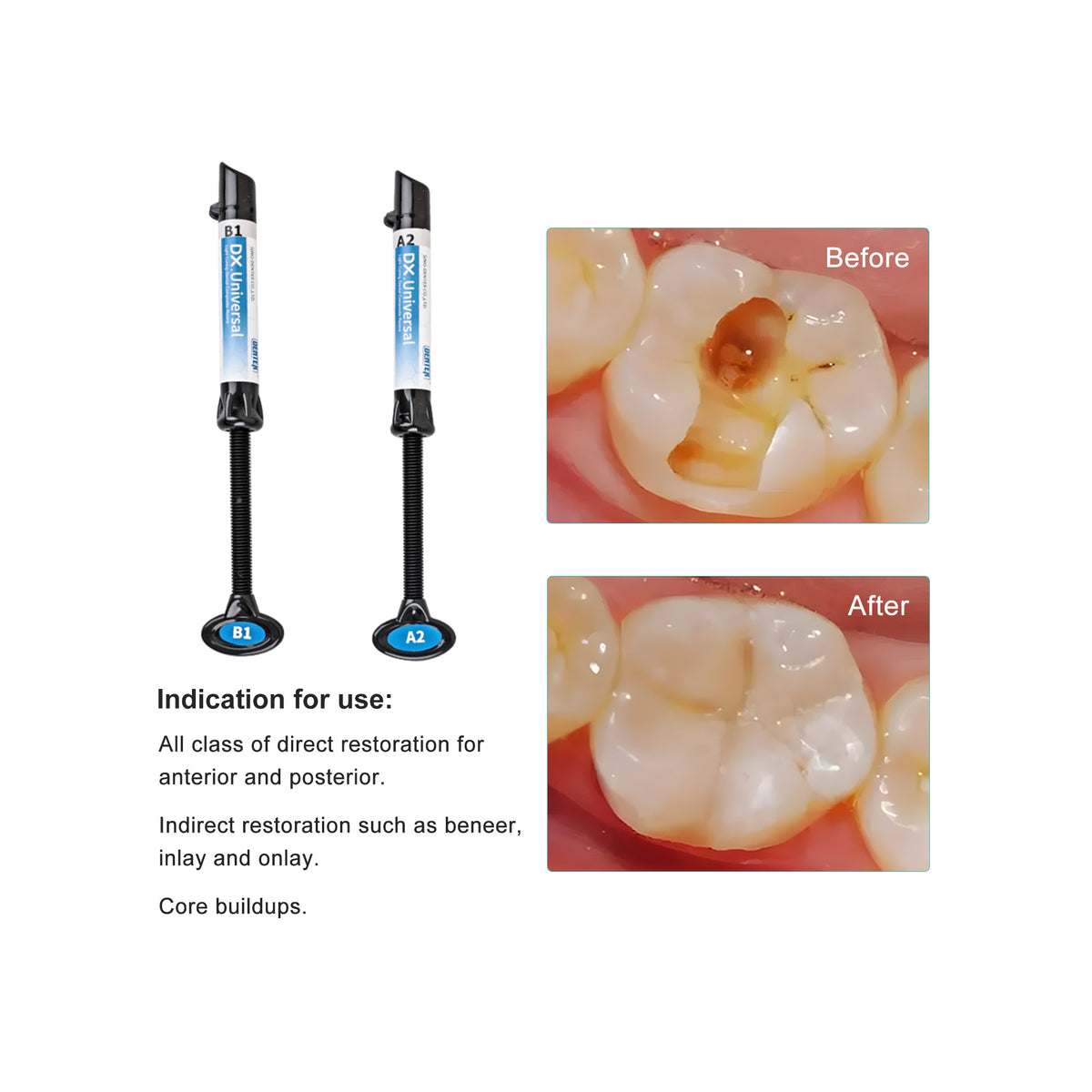 Posterior composite filling occlusal view