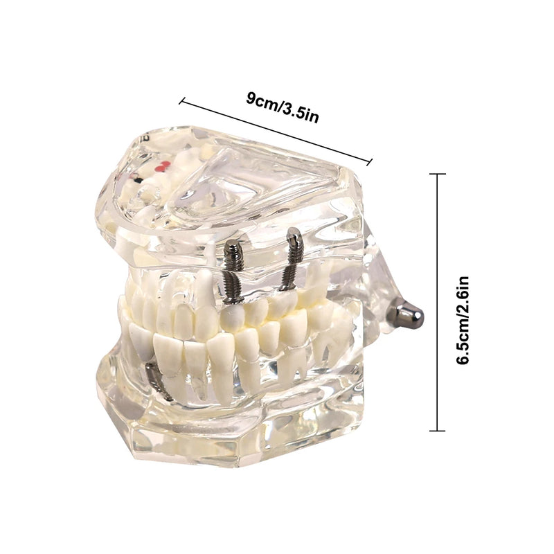 Dental Implantation Disease Teeth Mode with Restoration Bridge Tooth  Dentist Training and Teaching Model for Dental Implant
