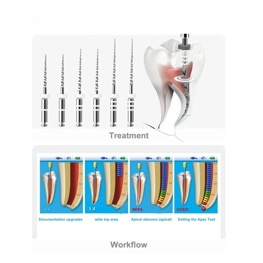 CYF211 Dental Retreatment Engine Root Canal NiTi File - Denspay Dental - D-Files