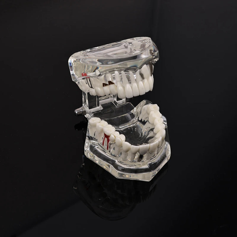Dental Implantation Disease Teeth Mode with Restoration Bridge Tooth  Dentist Training and Teaching Model for Dental Implant