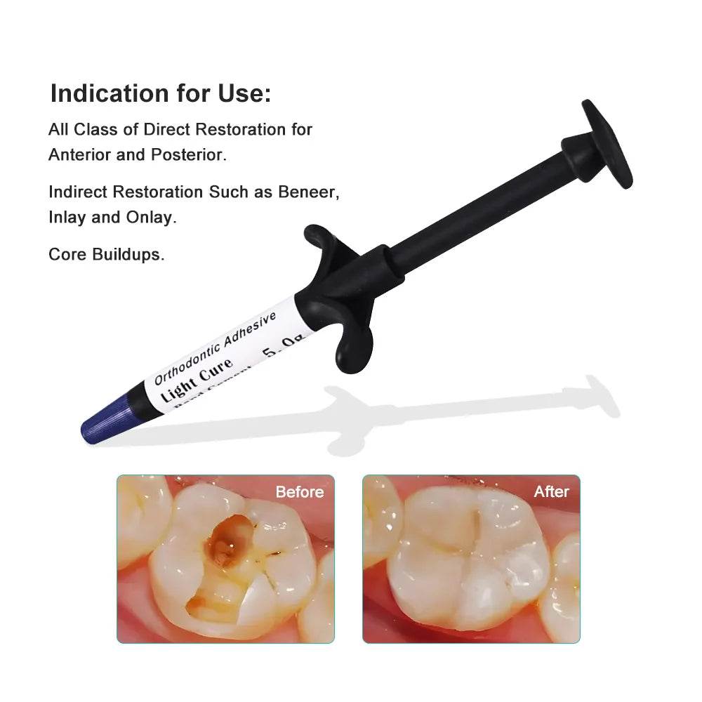 CYU157 Dental Orthodontic Adhesive Blue Glue - Denspay Dental - Composite Resin