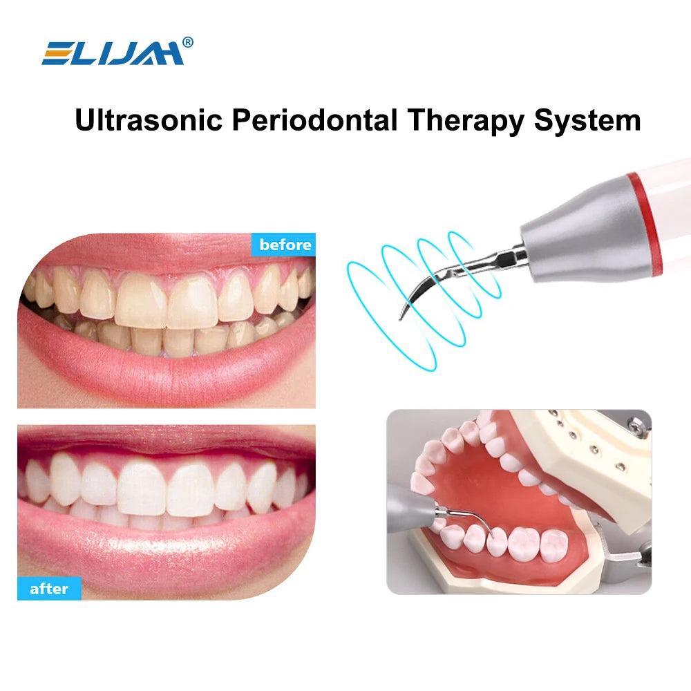 CYB093 Dental Built in Ultrasonic Scaler - Denspay Dental - Built-in Scaler