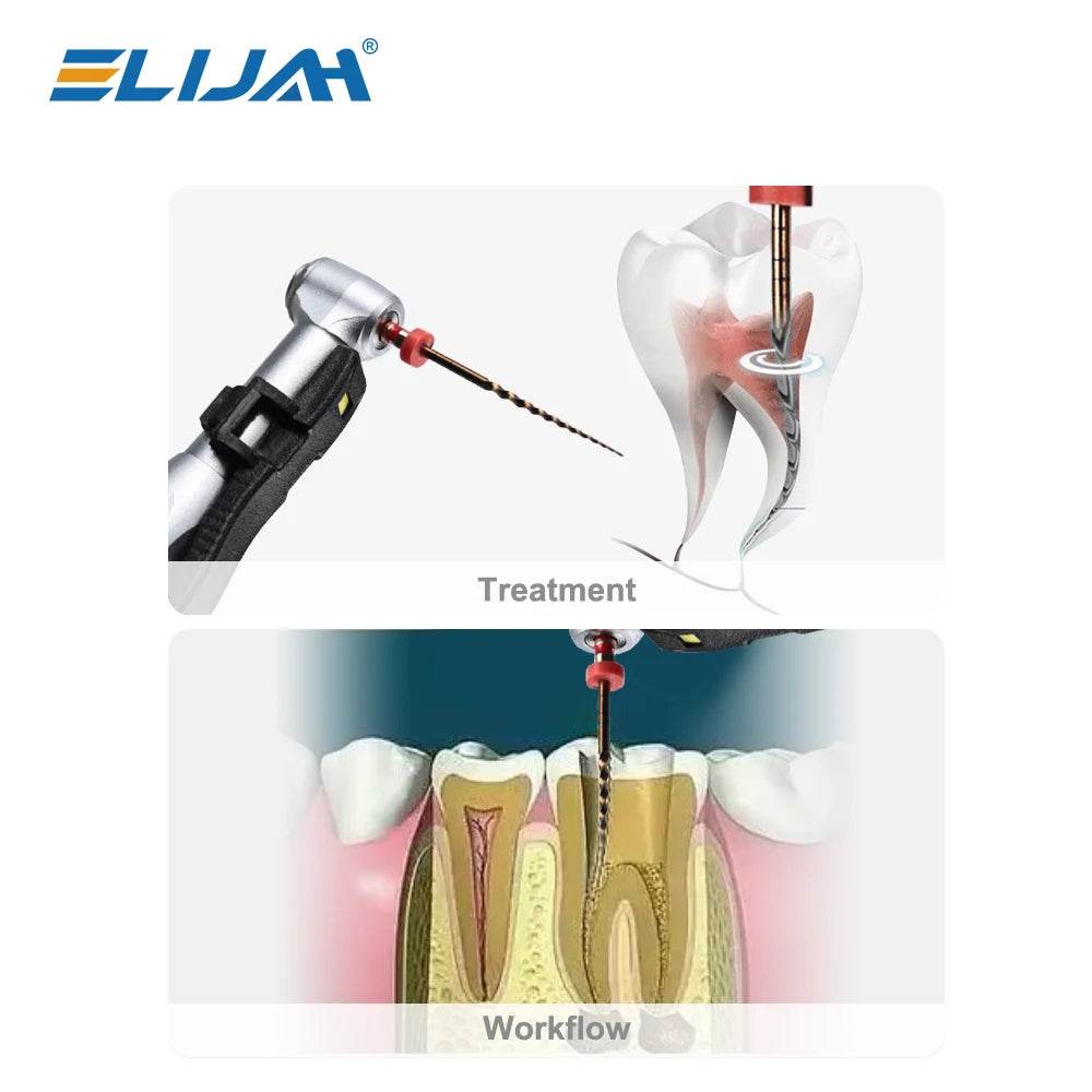 CYF225 Dental Heat-Activated Root Canal Files - Denspay Dental - Self-Adjusting Motor Files