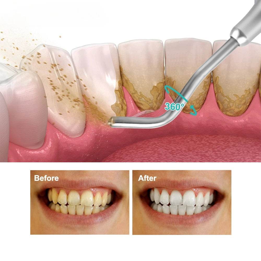 CYM034 Dental Sandblasting Powder - Denspay Dental - Air Polishing Powder