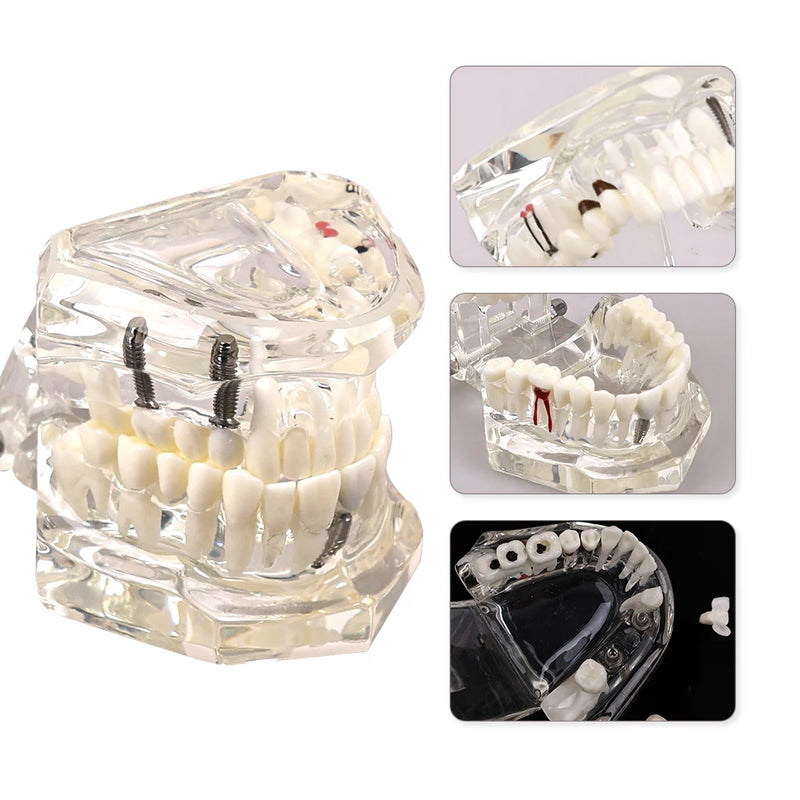 Dental Implantation Disease Teeth Mode with Restoration Bridge Tooth  Dentist Training and Teaching Model for Dental Implant