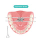 CYZ249 Dental Orthodontic Expansion Screw