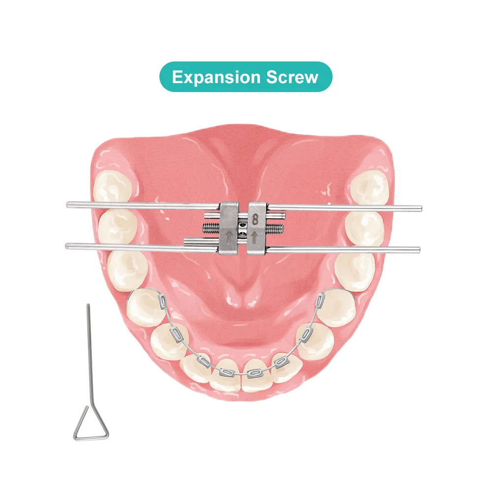 CYZ249 Dental Orthodontic Expansion Screw - Denspay Dental - Palatal Expanders