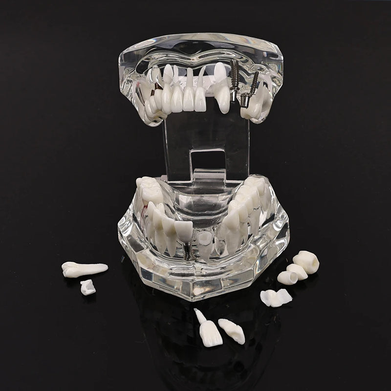Dental Implantation Disease Teeth Mode with Restoration Bridge Tooth  Dentist Training and Teaching Model for Dental Implant