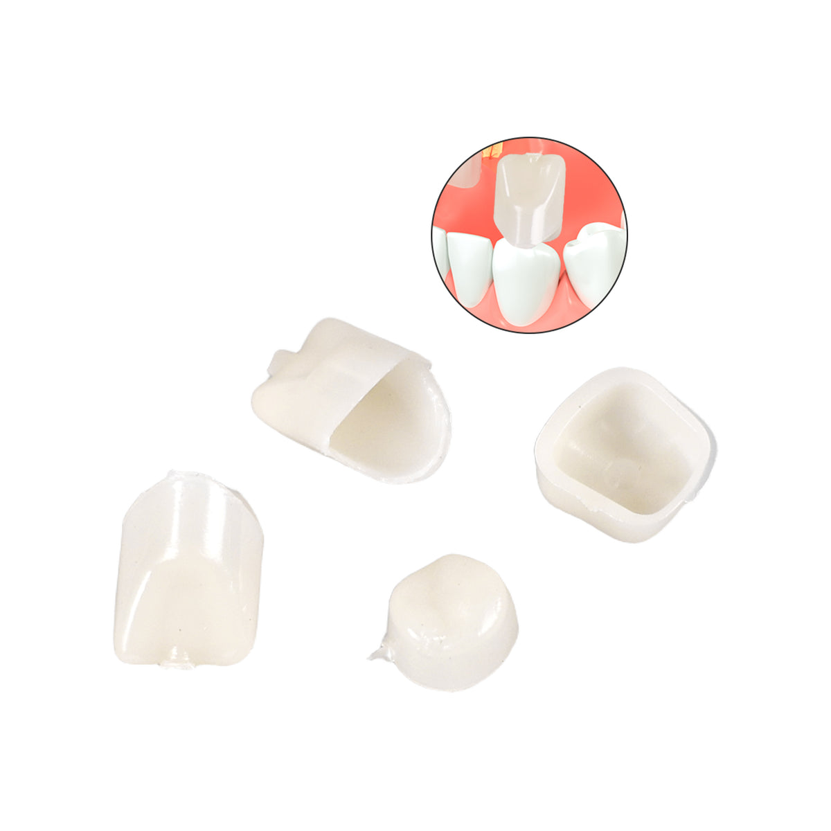 Temporary crown implant provisional restoration