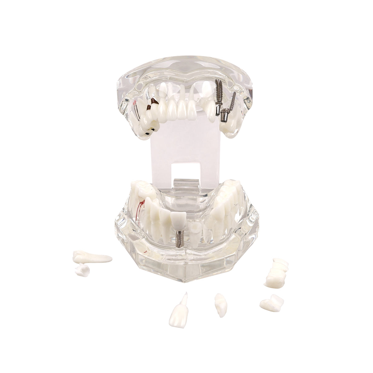 Top overlook view of transparent half jaw tooth model