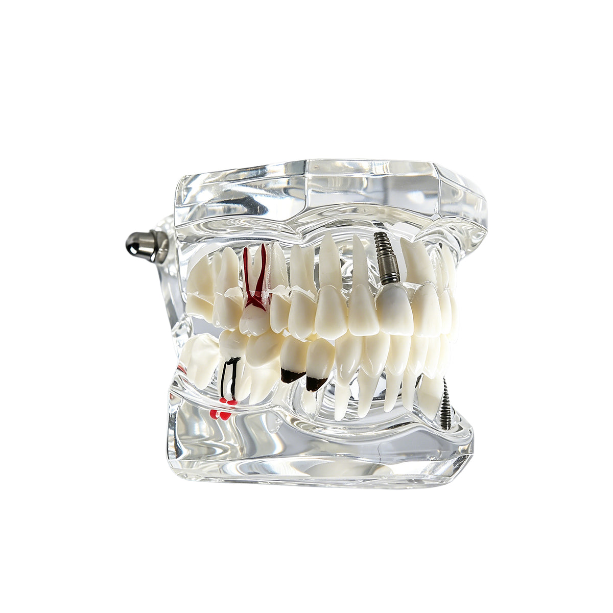Transparent dental pathological tooth model with implant caries root canal, white background