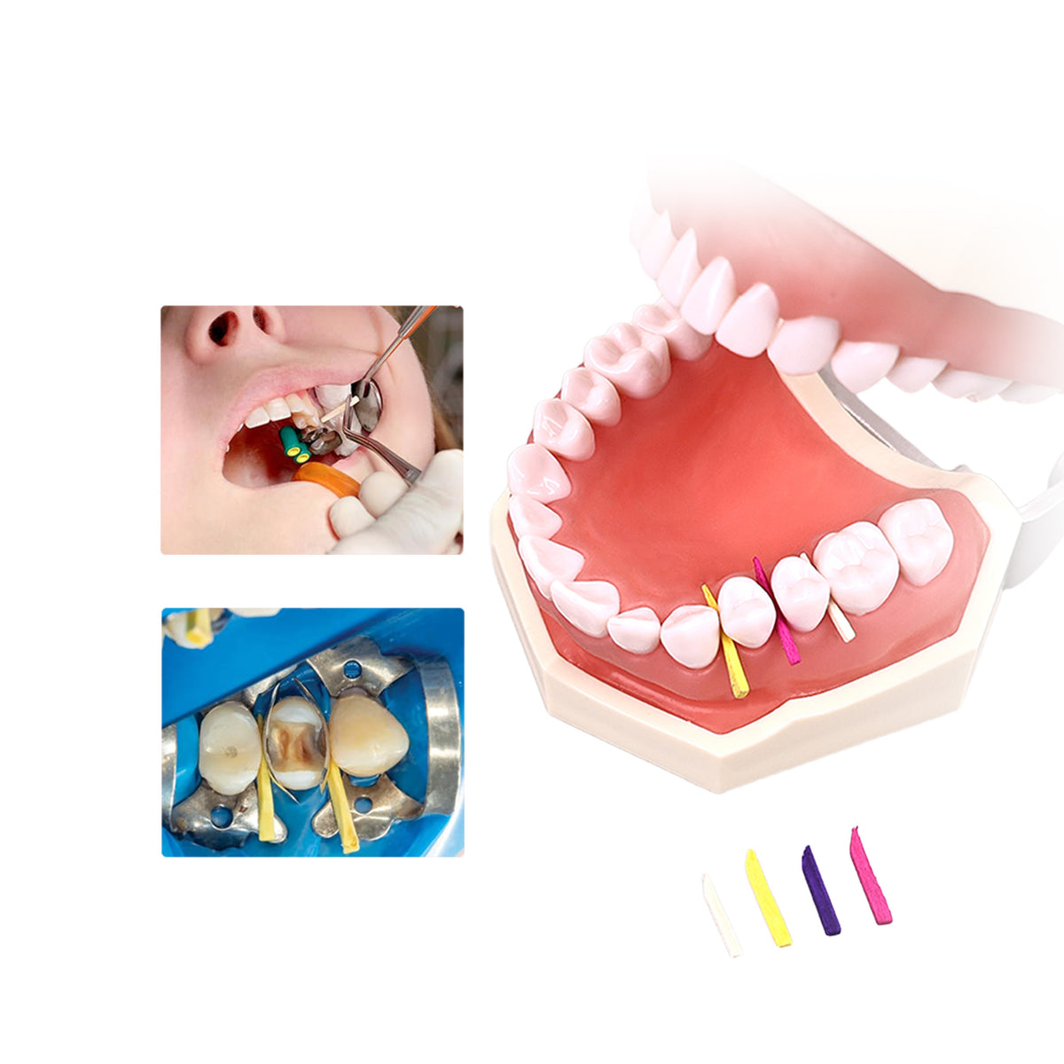 Wedge placed in interdental proximal cavity