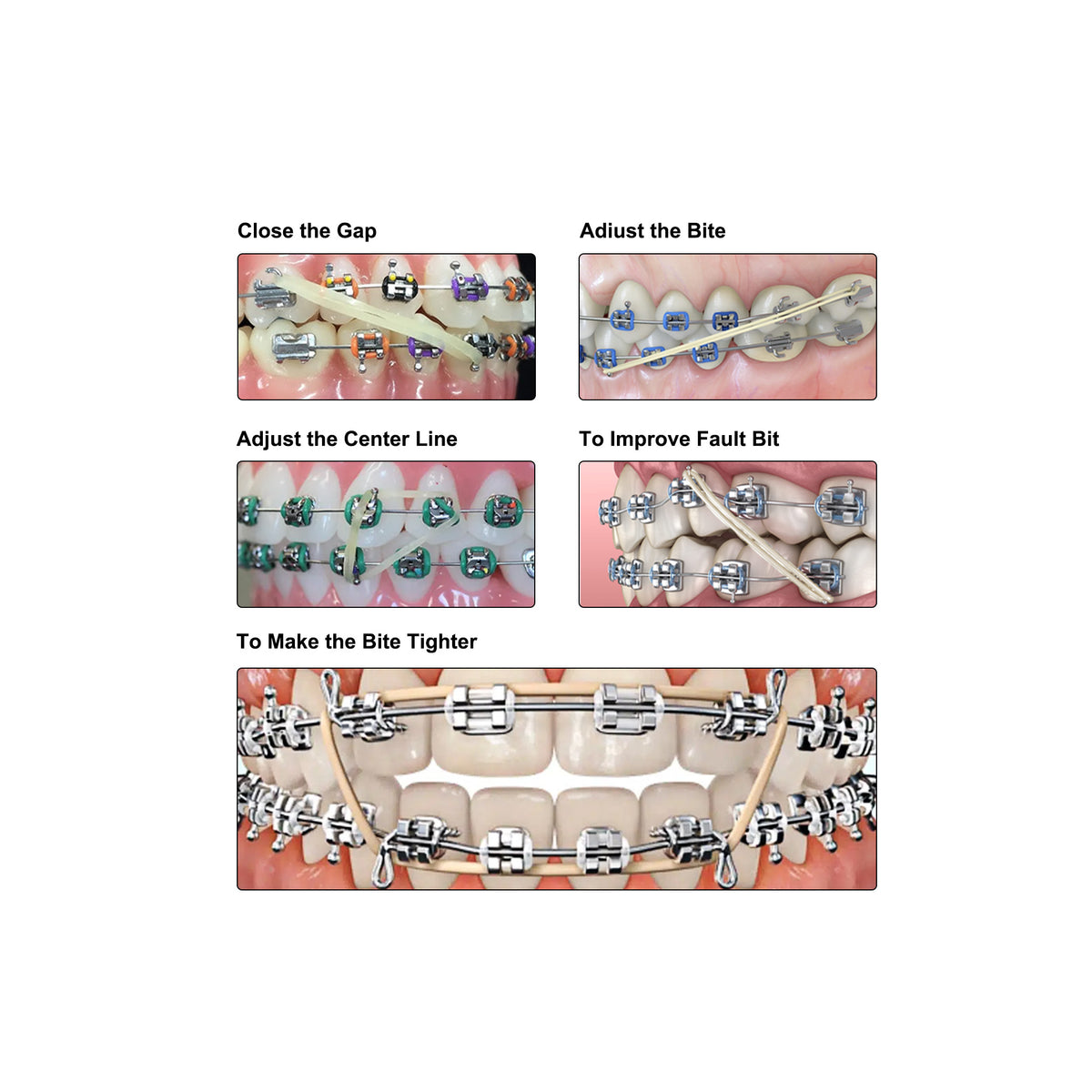 Patient putting orthodontic elastic rubber band