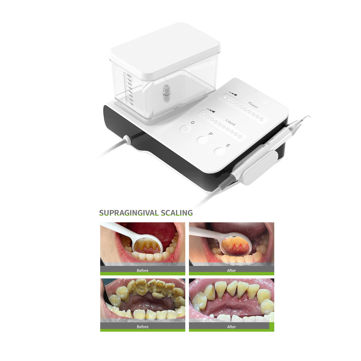 DA-20 LED scaler working in dental clinic treatment scene
