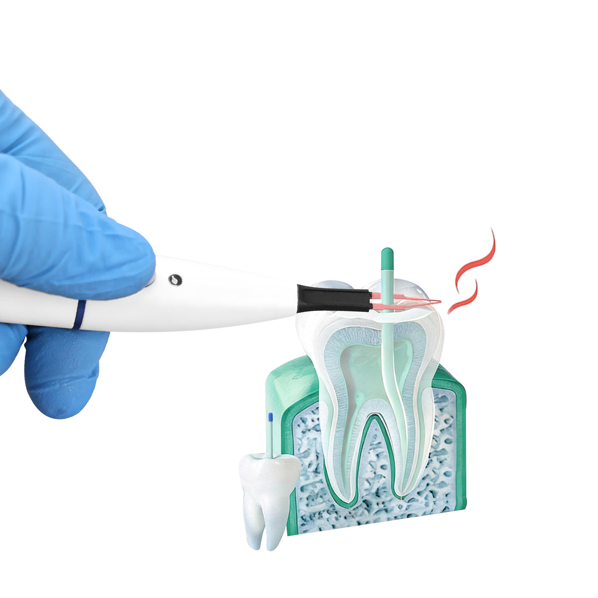 Clinical scene using gutta‑percha cutter after root‑canal filling