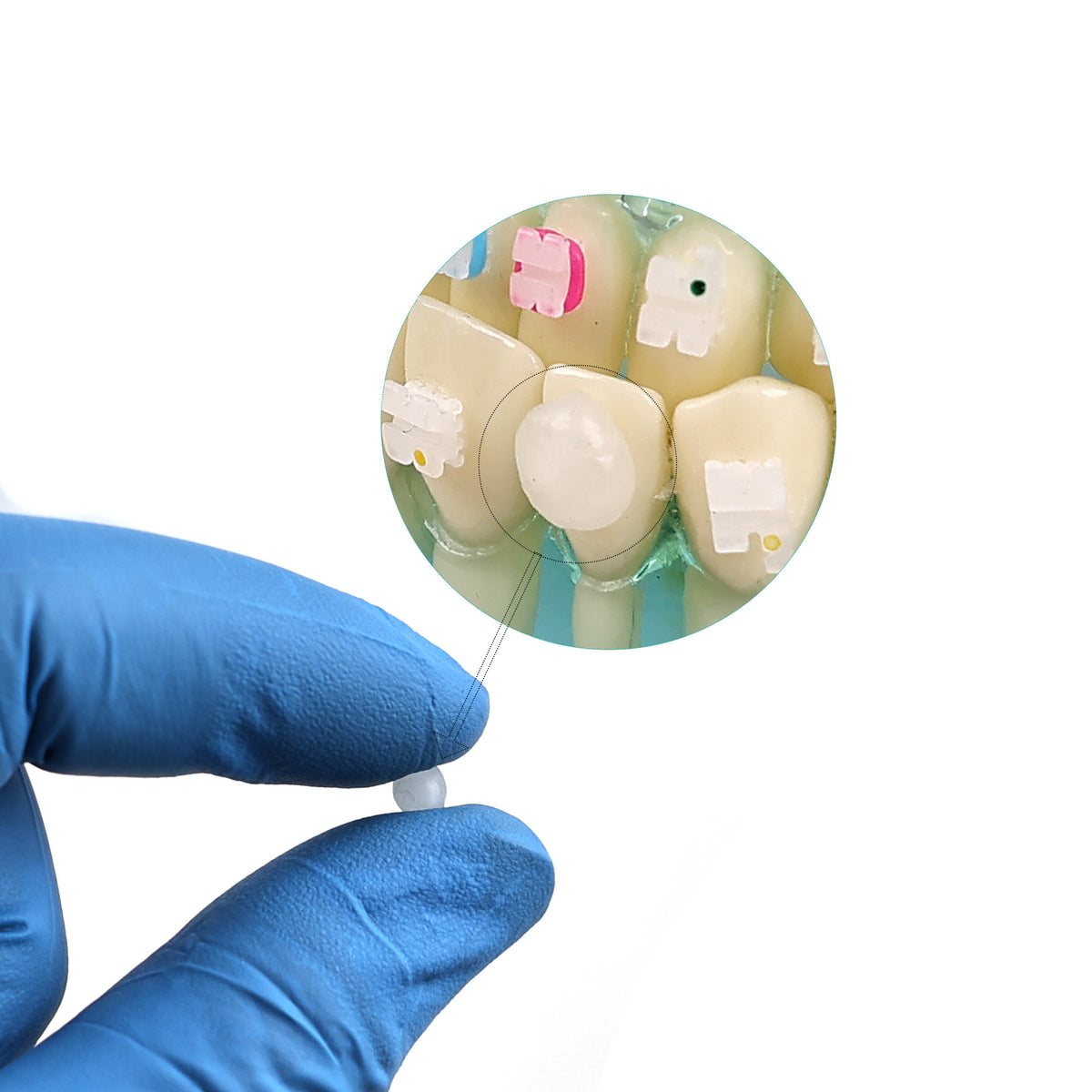 Orthodontic wax applied on bracket intraoral demo picture